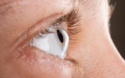 Scleral Lenses and Keratoconus: A Perfect Match for Improved Vision 